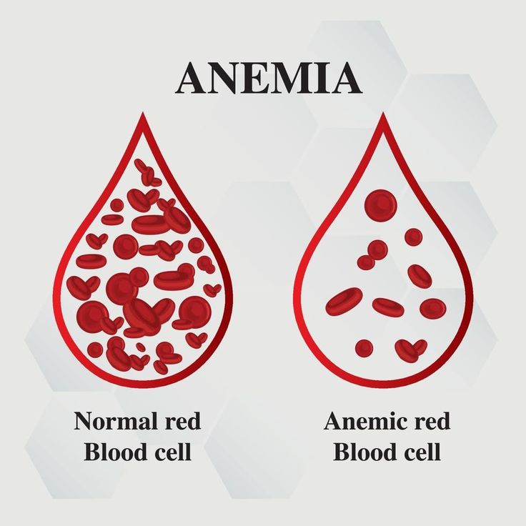 Anemia