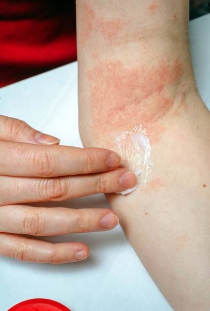 Dermatitis: Definition, Main Types, Causes, Symptoms, Diagnosis, and Treatment