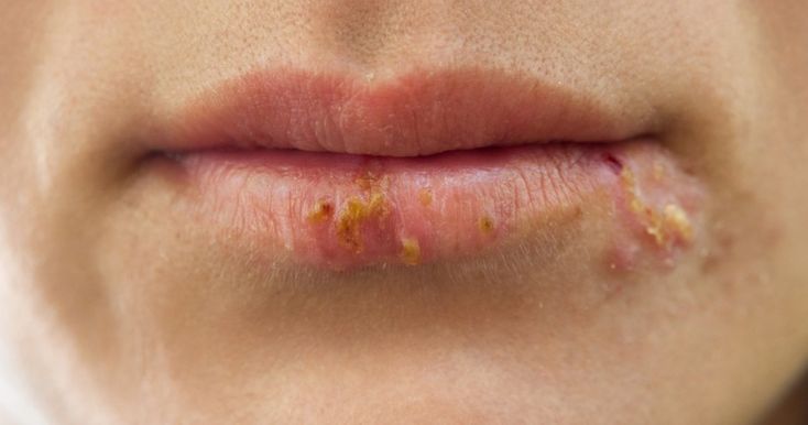 Herpes Again: Why It Comes Back and How to Fight It