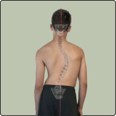 Scoliosis: What Causes It? What Are Its Symptoms? How Can It Be Corrected?